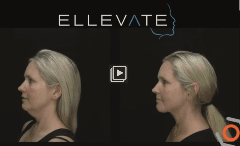 Ellevate before and after phot