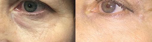 Accutite before and after photos, courtesy of Sean Paul, MD
