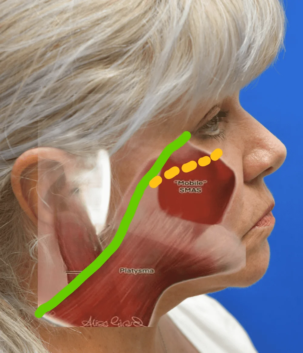 Accu-SMAS Deep Plane Rhytidectomy