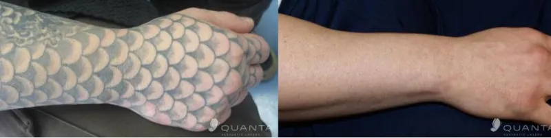 tattoo-removal-ba-006