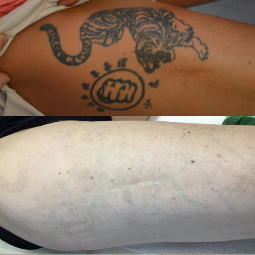 tattoo-removal-ba-007