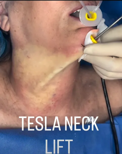 tesla-neck-lift